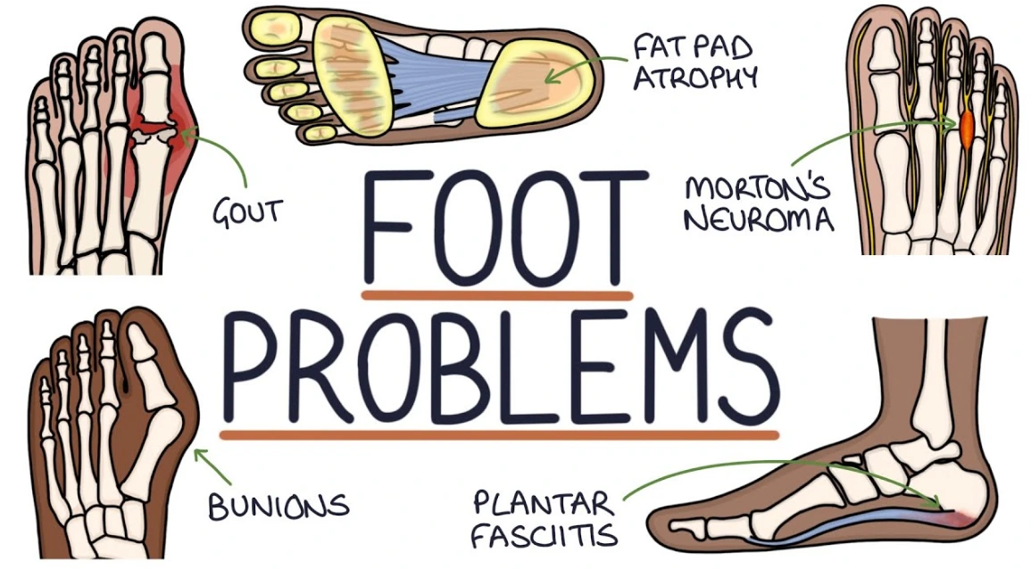 9 Common Foot Problems (Symptoms & Treatment) | Insole Clinic